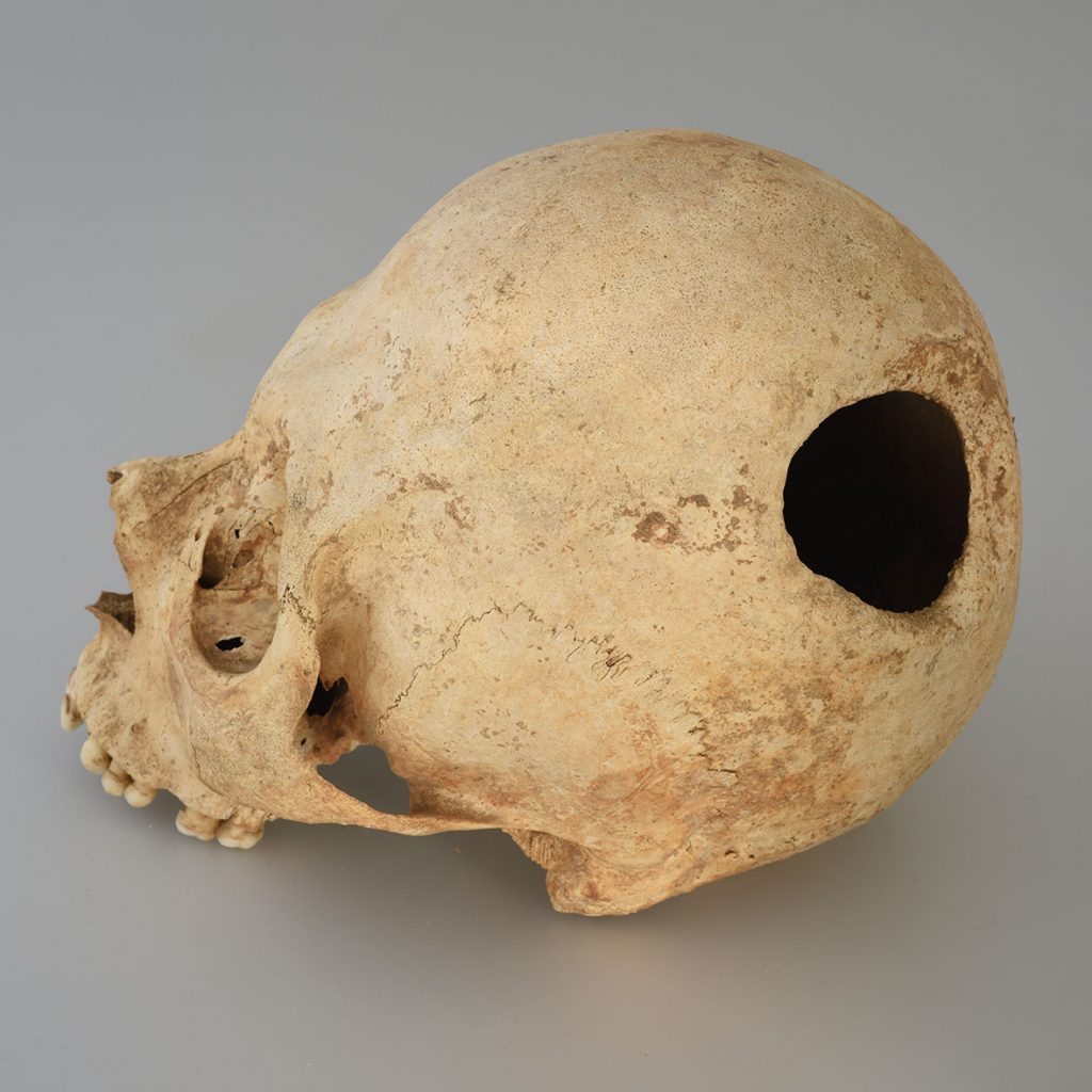 Cas de trépanation identifié dans la collection de Saint-Cosme. La présence d’os cicatriciel (os qui se forme après la création de l’ouverture) témoigne de la survie de l’individu après son intervention