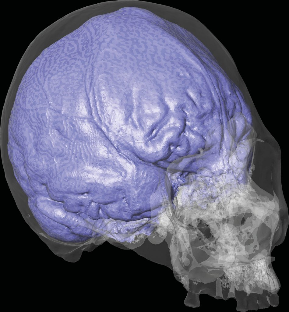 Reconstruction 3D du crâne (transparent) et de l’endocrâne (violet) de l’individu trépané. Les reliefs observables en zone frontale indiquent que l’individu souffrait de troubles neurologiques.
